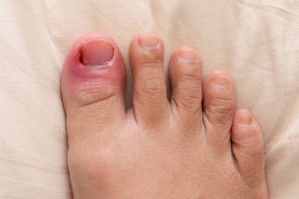Desprendimiento de uñas