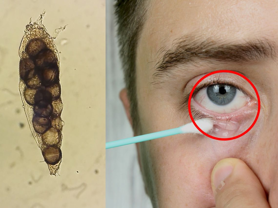 Demodex