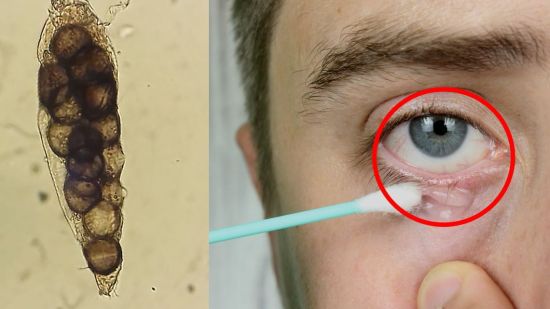 Demodex