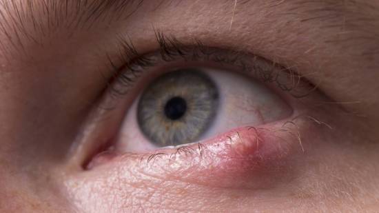 Ojo con orzuelo
