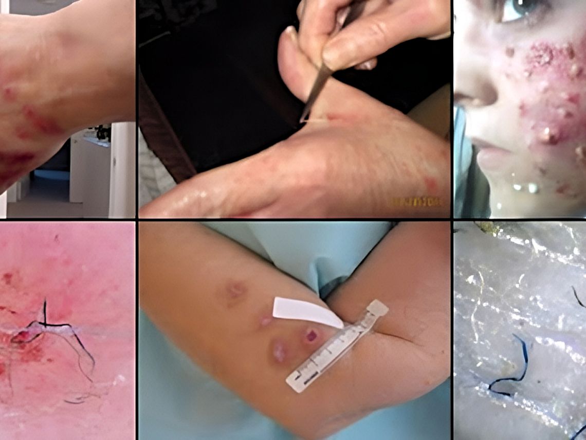Enfermedad de Morgellons.