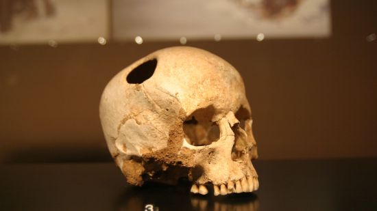 trepanacion1