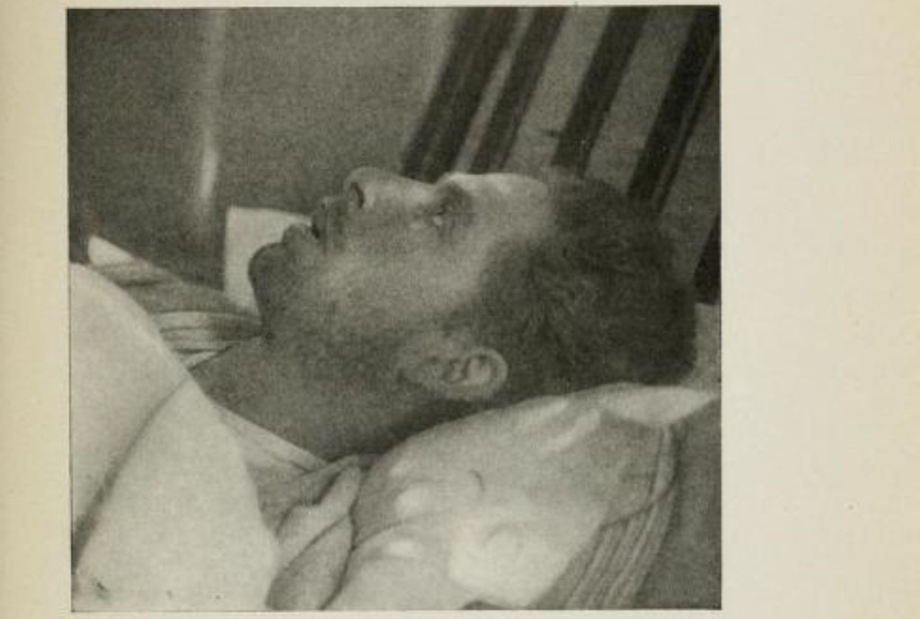 Foto de un paciente de encefalitis letárgica durante la epidemia 1917-1928