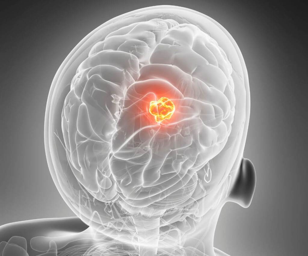 Neurocirugía