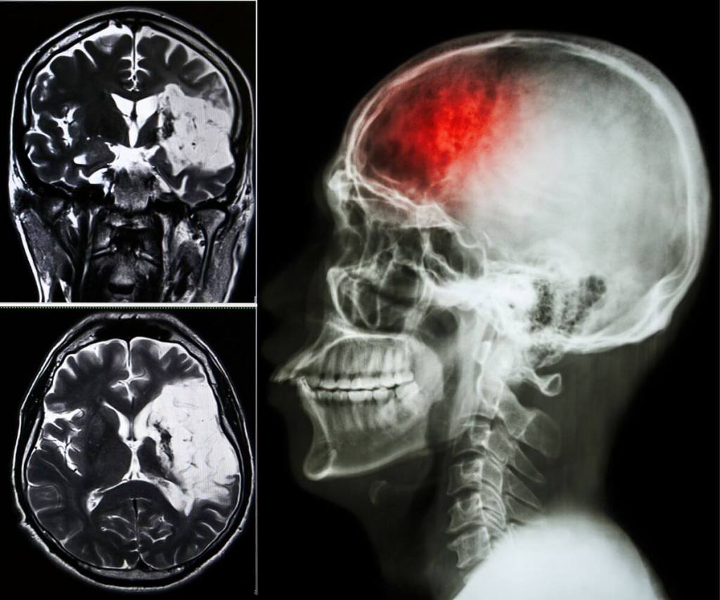 accidente cerebrovascular