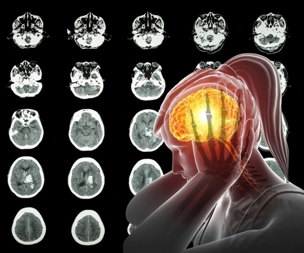 accidente cerebrovascular