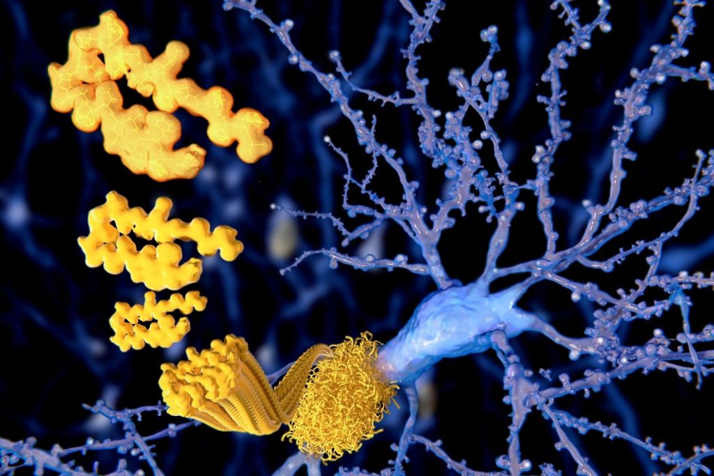 Acumulaciones de beta-amiloide entre las neuronas, una de las huellas distintivas del alzhéimer