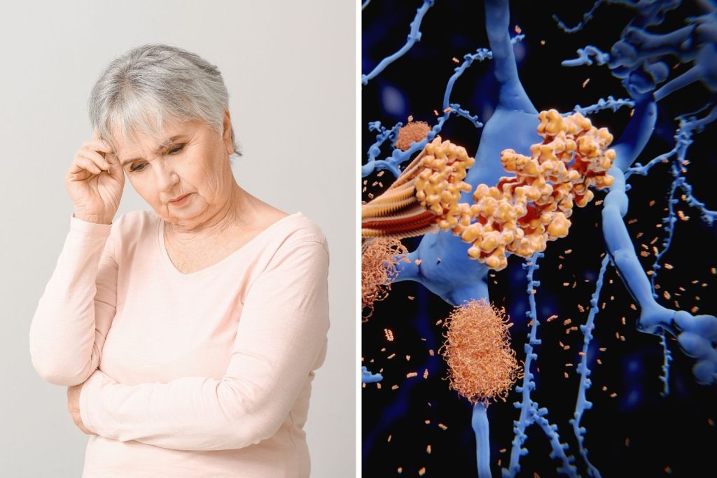 La neurodegeneración asociada al alzhéimer comienza décadas antes de los primeros síntomas clínicos
