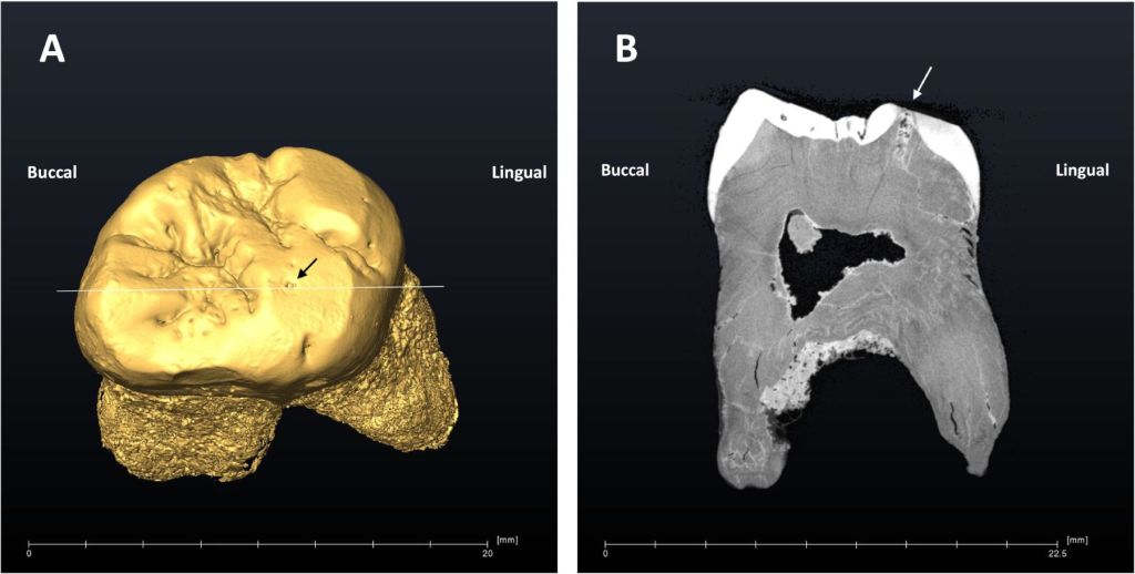 Caries neandertal