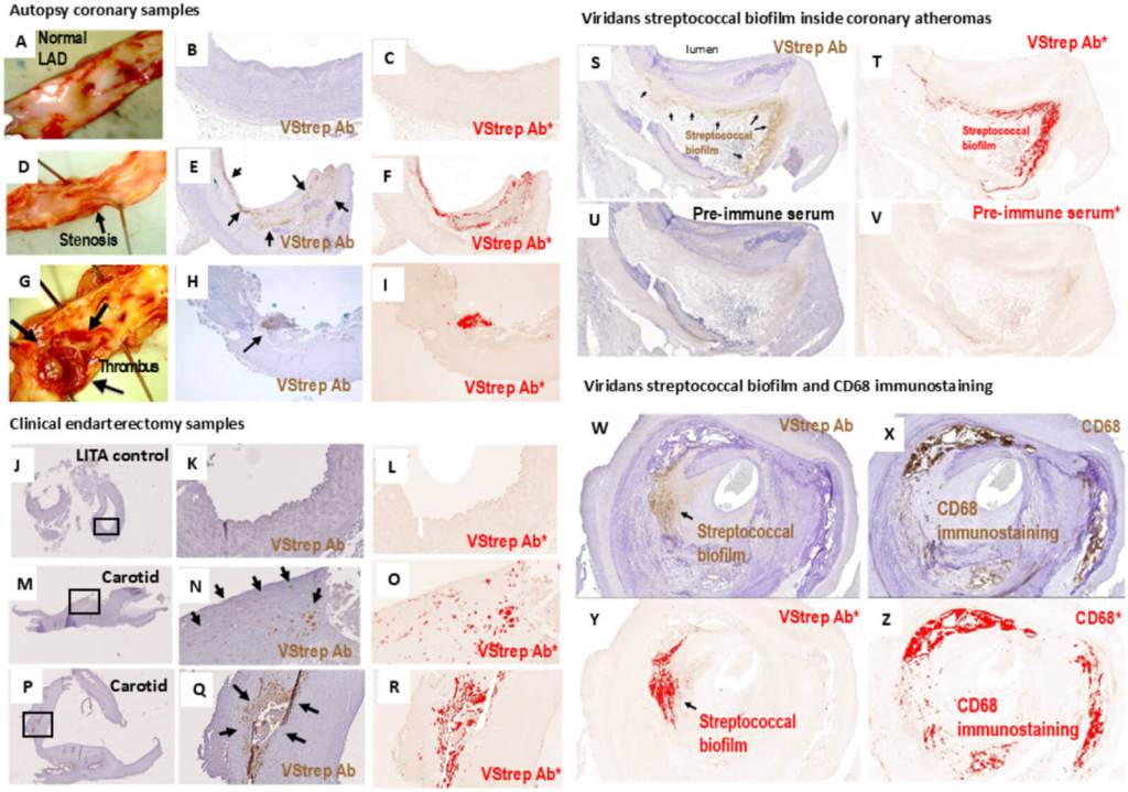 Un hallazgo sorprende a los científicos- bacterias orales se esconden en las arterias y podrían impulsar la ruptura que causa infartos. 3