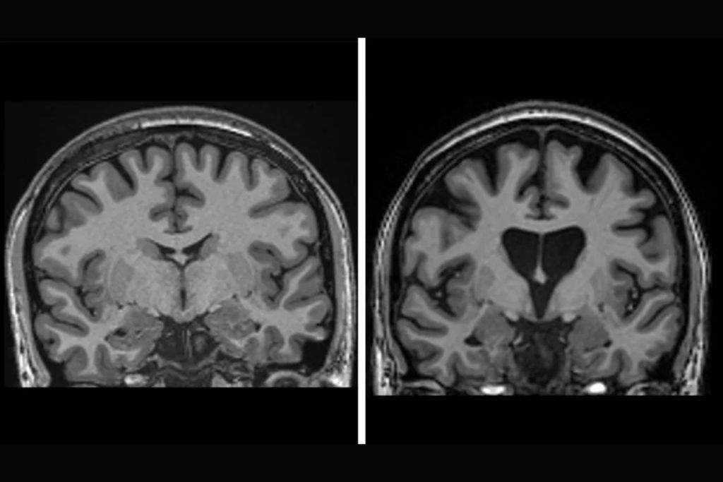 Comparativa de dos escáneres cerebrales: a la izquierda, un cerebro sano; a la derecha, uno afectado por la enfermedad de Huntington, con evidente pérdida de masa cerebral por la destrucción progresiva de neuronas